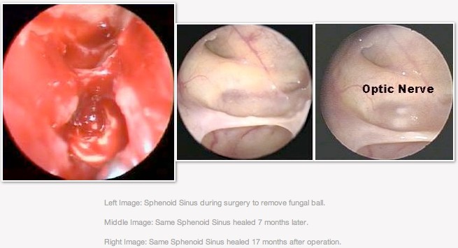 Rhinology Functional Endoplastic Sinus Surgery Fess St Paul S Sinus Centre Spsc